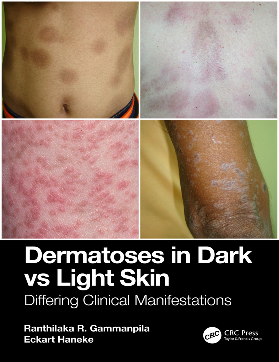 Dermatoses in Dark Vs Light Skin PDF Download